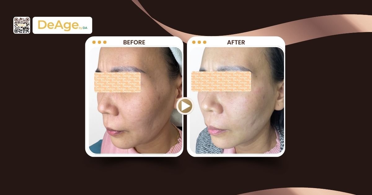 Lenisna: chất kích thích sinh học chứa PDLLA giúp làm đầy và trẻ hóa 4 LENISNA