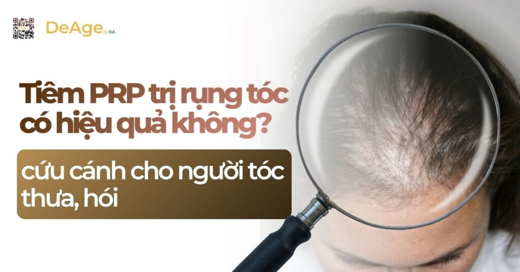 Tiêm PRP trị rụng tóc có hiệu quả không? Cứu cánh cho người tóc thưa, hói 8 TIÊU ĐỀ TIÊM PRP TRỊ RỤNG TÓC