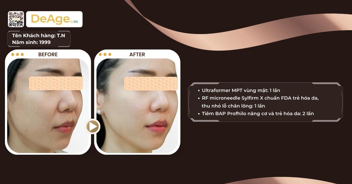 Nâng cơ HIFU giá bao nhiêu và đối tượng nào nên thực hiện? 6 ca lâm sàng hifu