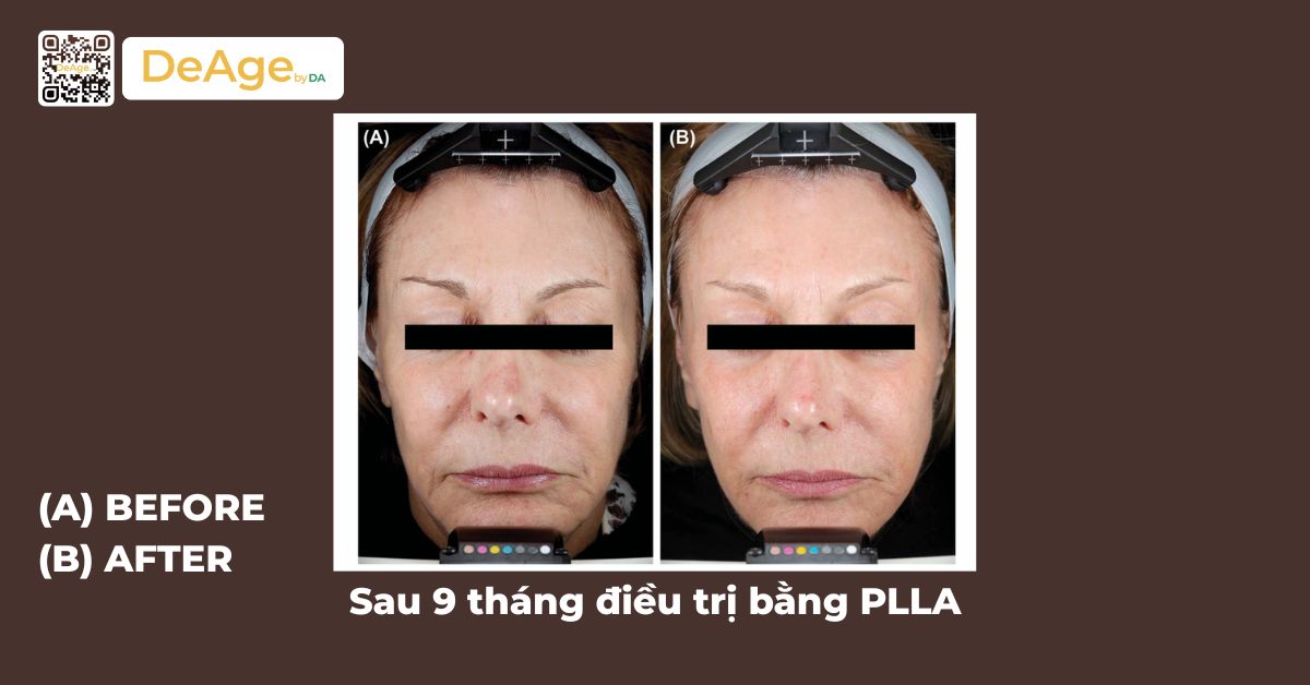 Sculptra là gì? Cơ chế hoạt động và hiệu quả trong trẻ hóa da 5 ca lâm sàng sculptra