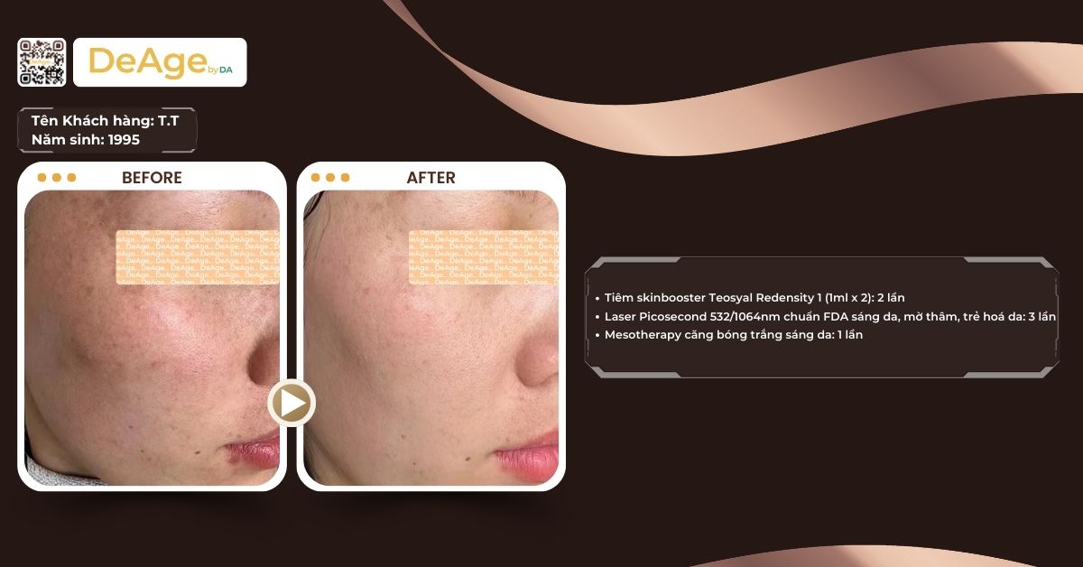 Dùng retinol trị nám có hiệu quả như lời đồn và cách sử dụng hiệu quả nhất 6 ca lâm sàng trị nám