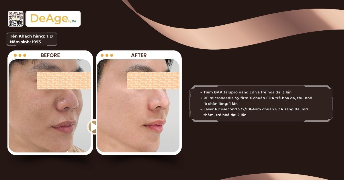 Vi kim RF Virtue là gì? So sánh với thiết bị Sylfirm X 4 ca lâm sàng