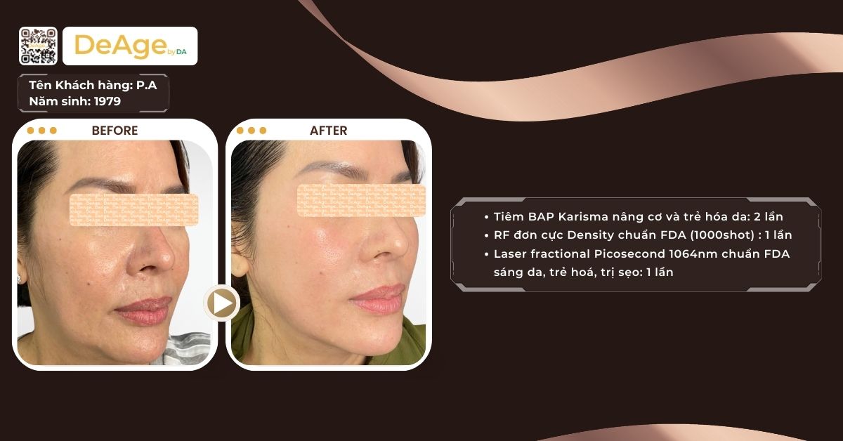 Nâng cơ RF giá bao nhiêu? Cần bao nhiêu lần để đạt hiệu quả? 8 cls density