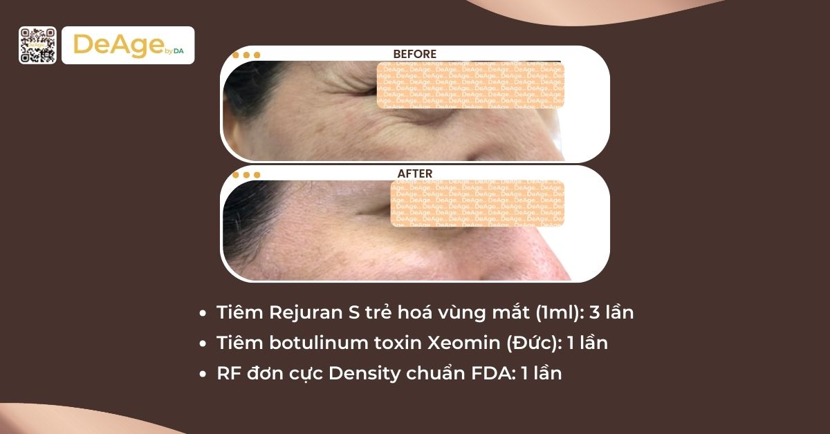 3 giải pháp làm đầy vùng trũng mắt giúp ánh nhìn rạng rỡ hơn 4 cls trẻ hóa vũng mắt