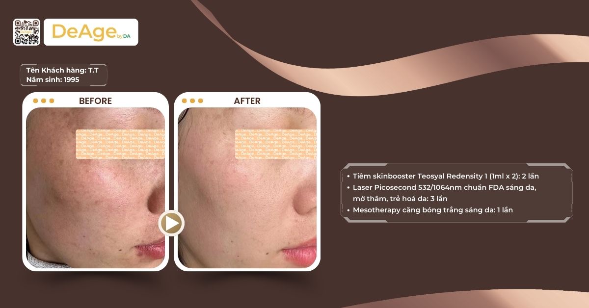 Da bị nám do nắng: nguyên nhân và cách điều trị để da nhanh chóng phục hồi 6 cls trị nám