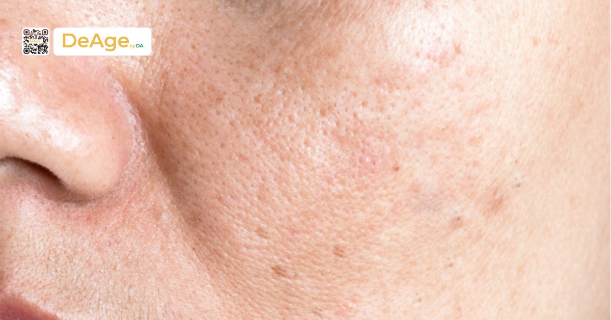 Dùng retinol trị nám có hiệu quả như lời đồn và cách sử dụng hiệu quả nhất 1 da bị nám