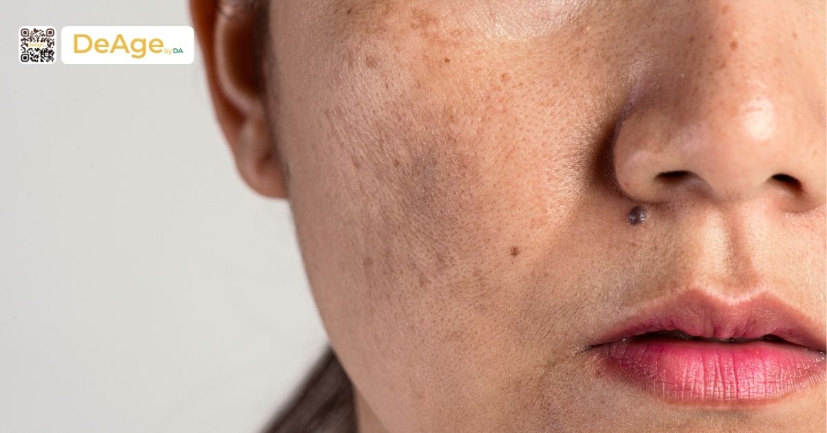 Nám da thai kỳ: làm sao để ngăn ngừa và điều trị an toàn cho bà bầu 7 nám da