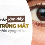 3 giải pháp làm đầy vùng trũng mắt giúp ánh nhìn rạng rỡ hơn