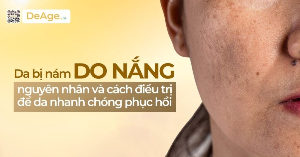 Da bị nám do nắng: nguyên nhân và cách điều trị để da nhanh chóng phục hồi 12 tiêu đề bị nám do nắng