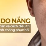 Da bị nám do nắng: nguyên nhân và cách điều trị để da nhanh chóng phục hồi