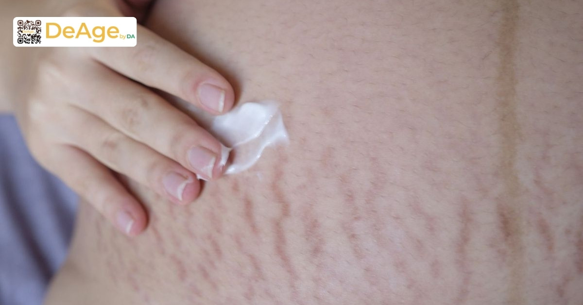 Vết rạn da bị ngứa sau sinh: nguyên nhân và cách điều trị an toàn 4 Bôi kem dưỡng vùng da rạn