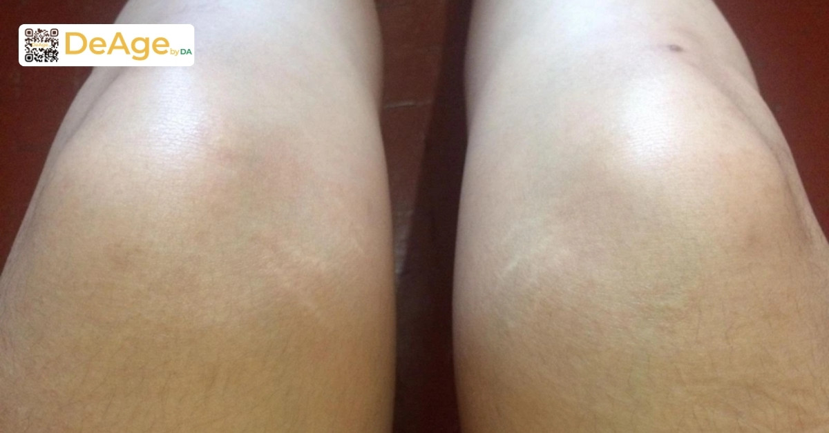 Cách nhận biết và điều trị rạn da đầu gối hiệu quả 1 Hình rạn da đầu gối