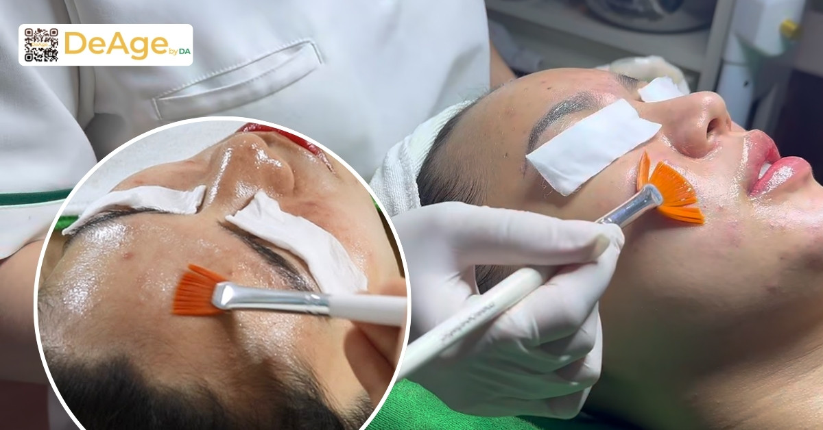 Nếp nhăn tĩnh: dấu hiệu nhận biết, nguyên nhân và giải pháp cải thiện 14 ktv peel