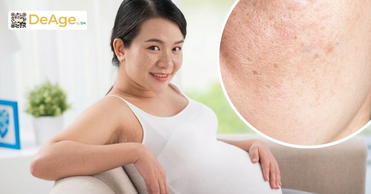 Nám da thai kỳ: làm sao để ngăn ngừa và điều trị an toàn cho bà bầu 1 nám da thai kỳ