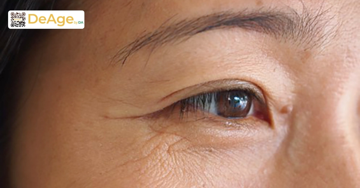 Top 10 phương pháp trẻ hóa vùng mắt hiệu quả hiện nay 1 Nếp nhăn vùng mắt