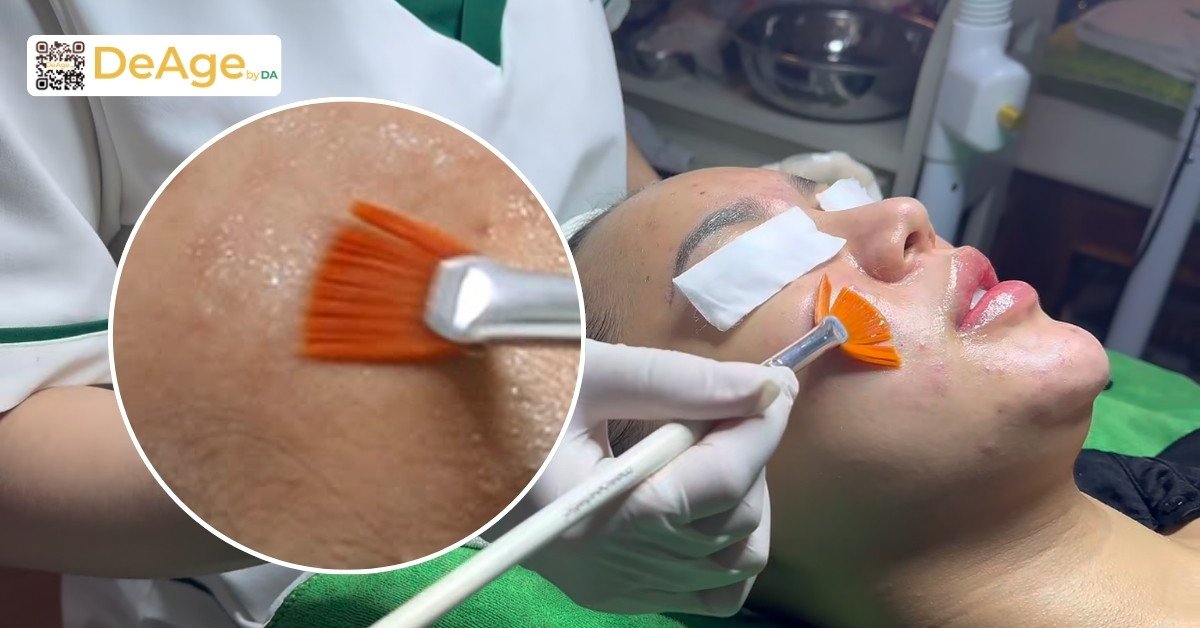 Nám da thai kỳ: làm sao để ngăn ngừa và điều trị an toàn cho bà bầu 8 peel da nám