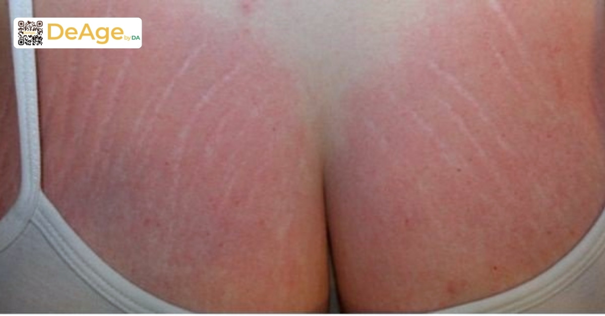 Rạn da ngực khi mang thai - nỗi lo thầm kín và cách cải thiện an toàn 3 Rạn da khi mang thai