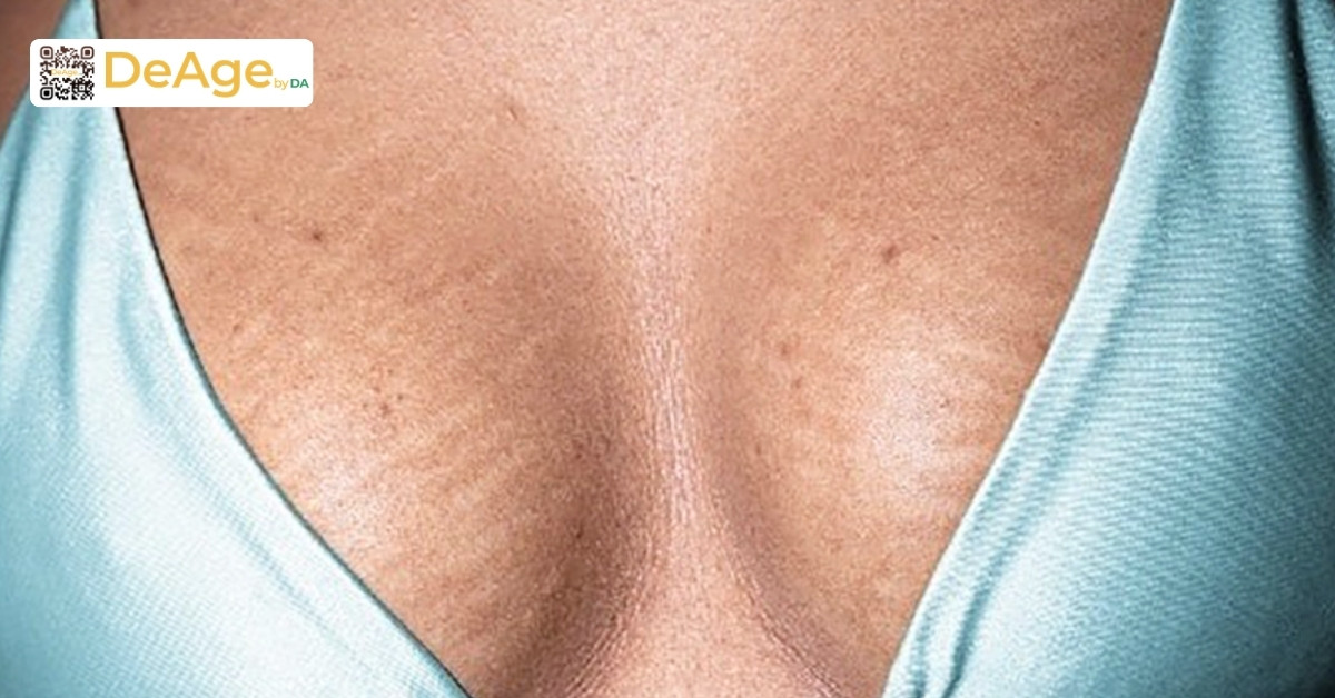 Rạn da ngực khi mang thai - nỗi lo thầm kín và cách cải thiện an toàn 1 Rạn da ngực