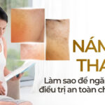 Nám da thai kỳ: làm sao để ngăn ngừa và điều trị an toàn cho bà bầu