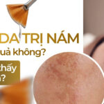 Peel da trị nám có hiệu quả không? Bao lâu thấy hiệu quả?