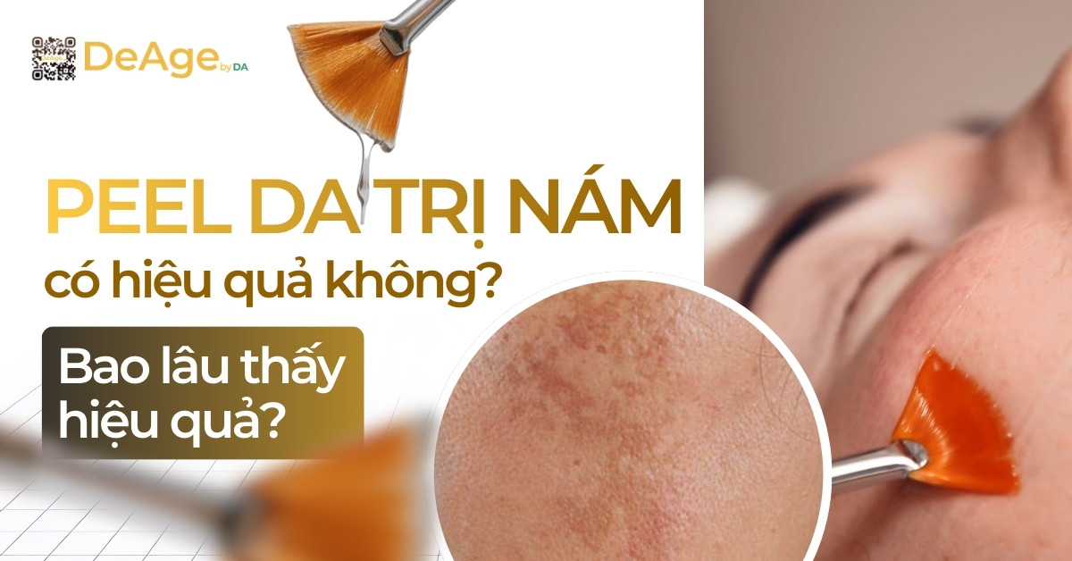 Thumb Peel da trị nám