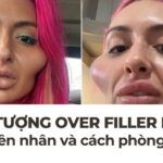 Hiện tượng over filler là gì? Nguyên nhân và cách phòng tránh