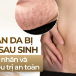 Vết rạn da bị ngứa sau sinh: nguyên nhân và cách điều trị an toàn