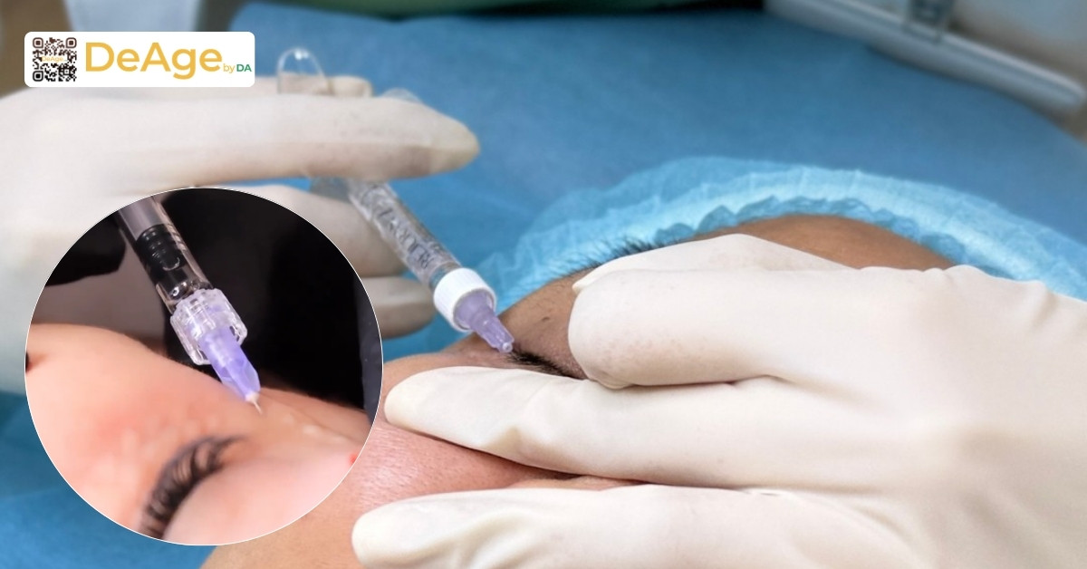 Top 10 phương pháp trẻ hóa vùng mắt hiệu quả hiện nay 10 tiêm rejuran i