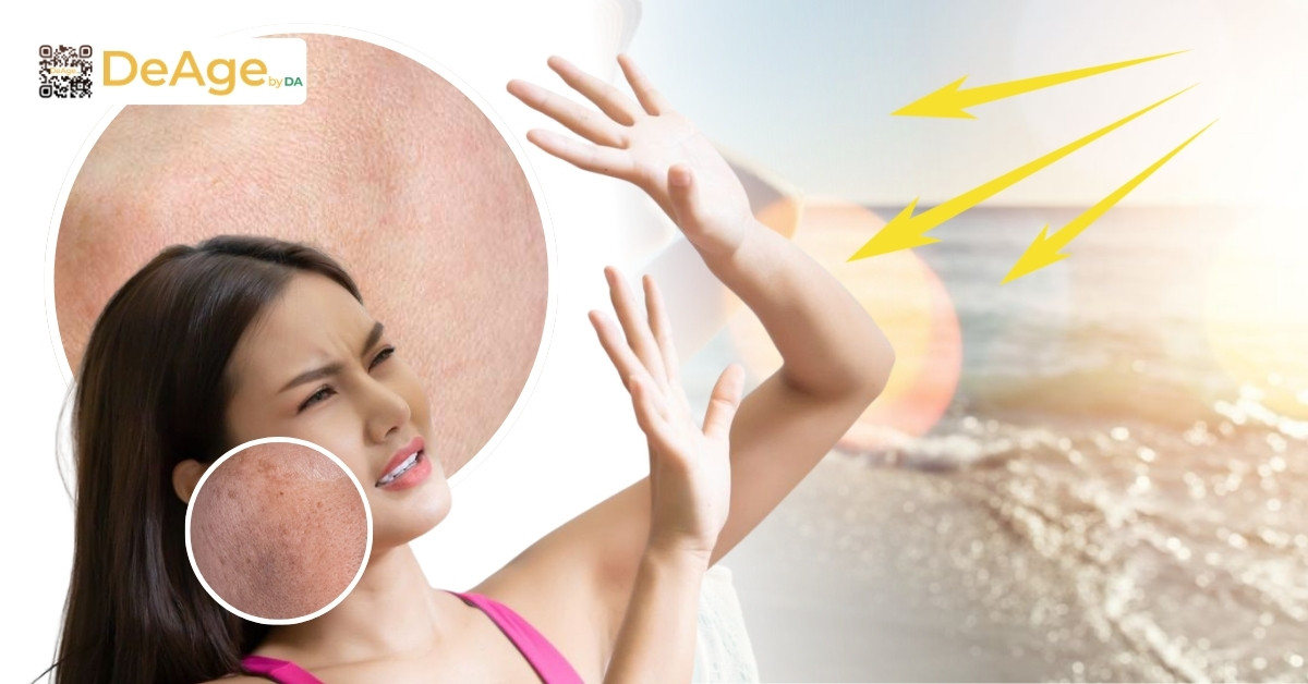 Nám da thai kỳ: làm sao để ngăn ngừa và điều trị an toàn cho bà bầu 5 tiếp xúc ánh nắng gây nám da