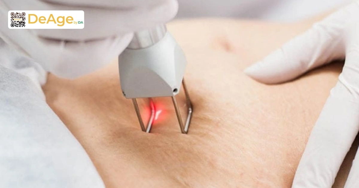 Cách nhận biết và điều trị rạn da đầu gối hiệu quả 7 Trị rạn bằng laser