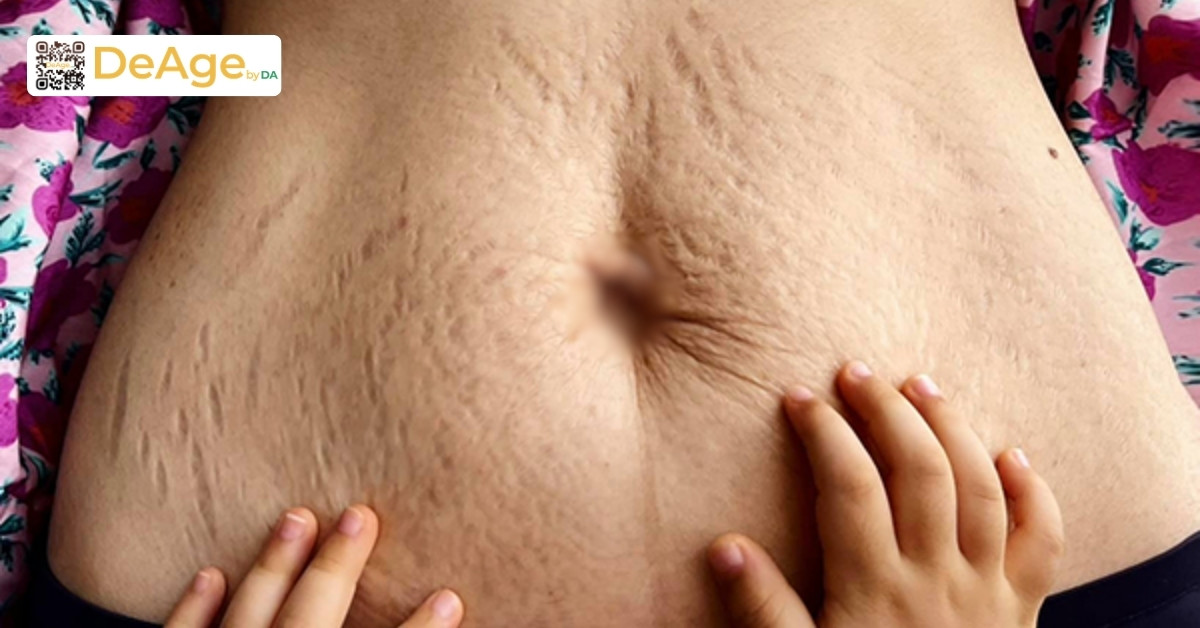 Vết rạn da bị ngứa sau sinh: nguyên nhân và cách điều trị an toàn 1 Vết rạn da sau sinh (2)