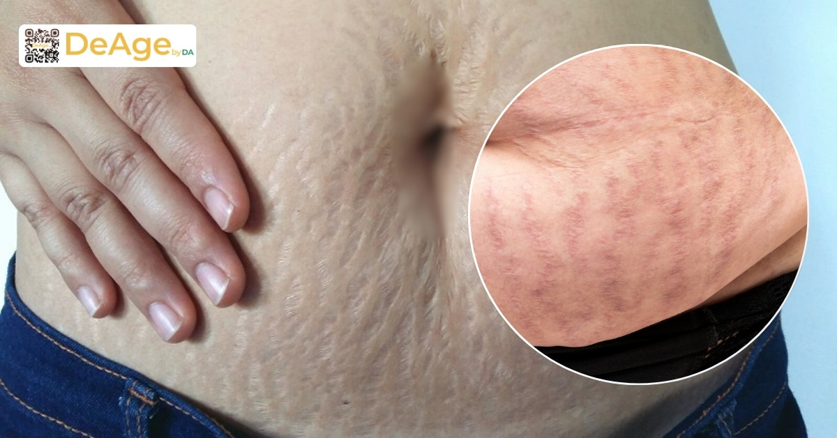 Vết rạn da bị ngứa sau sinh: nguyên nhân và cách điều trị an toàn 3 Vết rạn da sau sinh