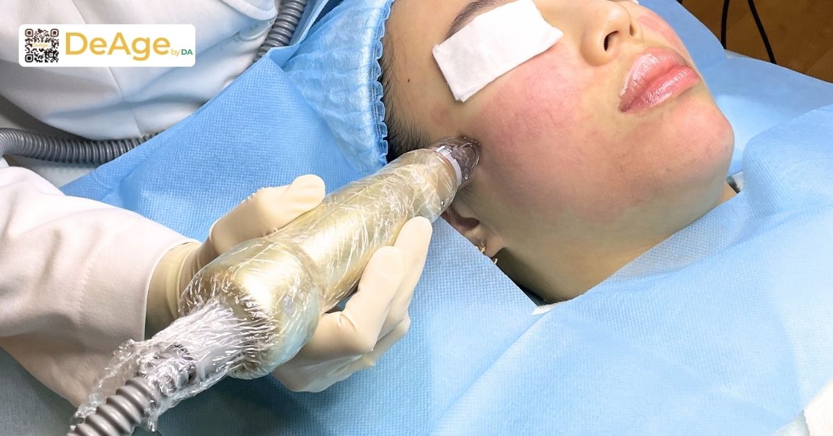 Căng chỉ collagen: cơ chế hoạt động và hiệu quả nâng cơ trẻ hóa da 12 bác sĩ kết hợp thêm vi kim RF nhằm tăng mức độ cải thiện
