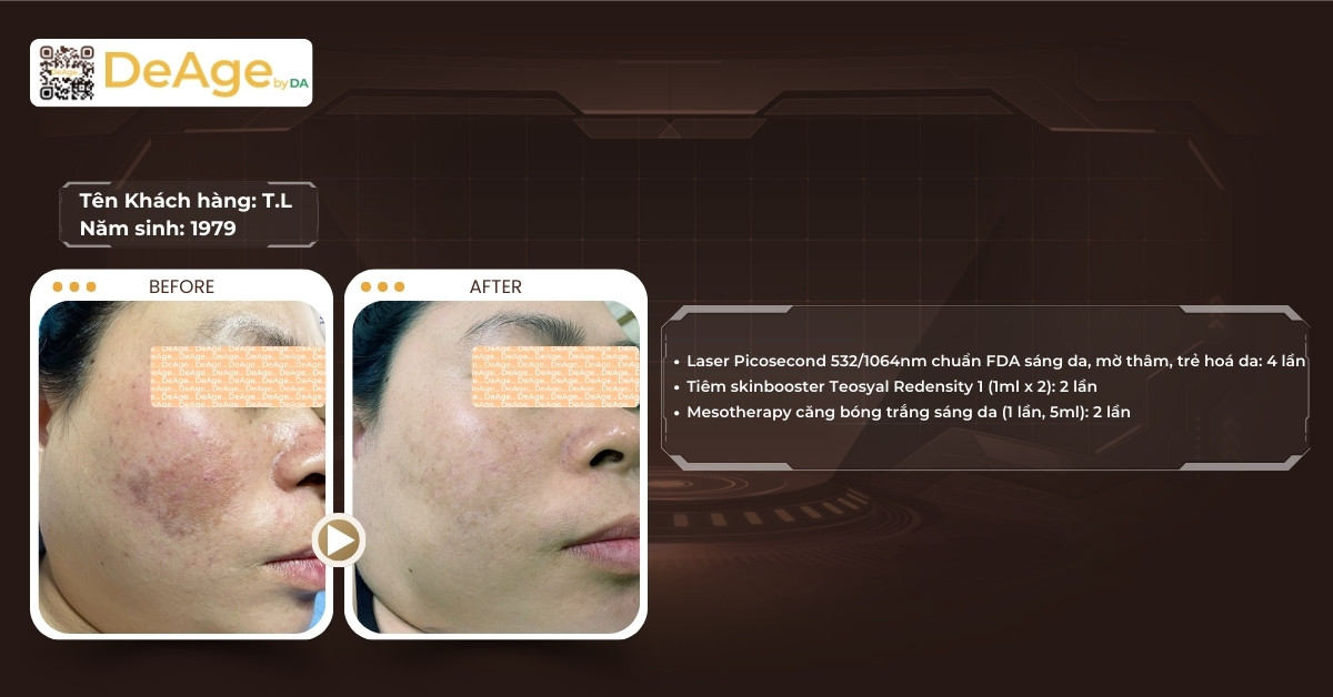 Melanin và nám da: chuyện gì xảy ra dưới da mỗi ngày? 12 ca lâm sàng nám da