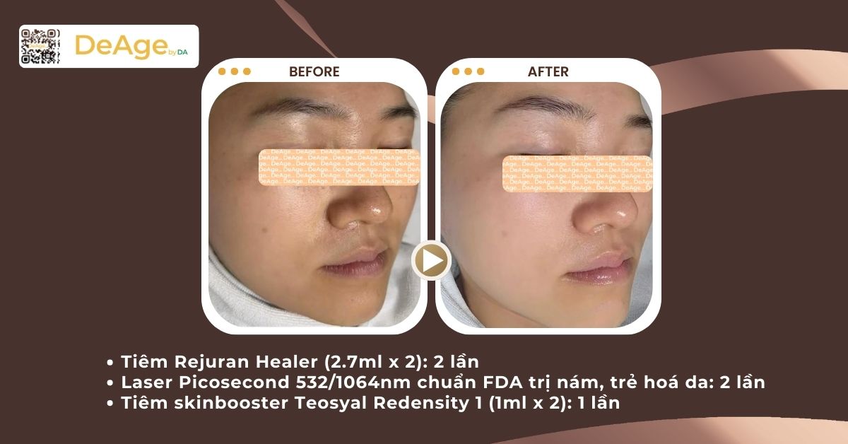 Liệu trình trẻ hóa da mặt giá bao nhiêu? Cập nhật bảng giá mới nhất tại DeAge 13 ca lâm sàng trẻ hóa da