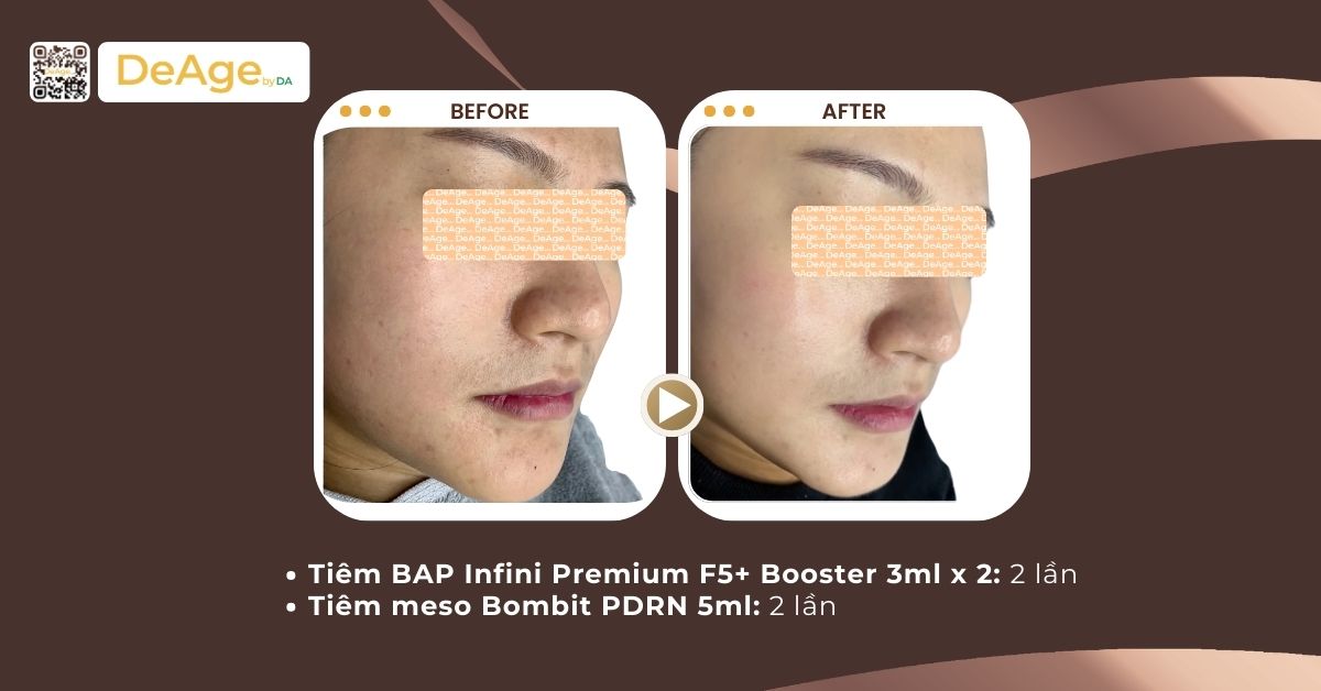 Succinic acid là gì? Lợi ích và ứng dụng trong trẻ hóa da 4 ca lâm sàng'