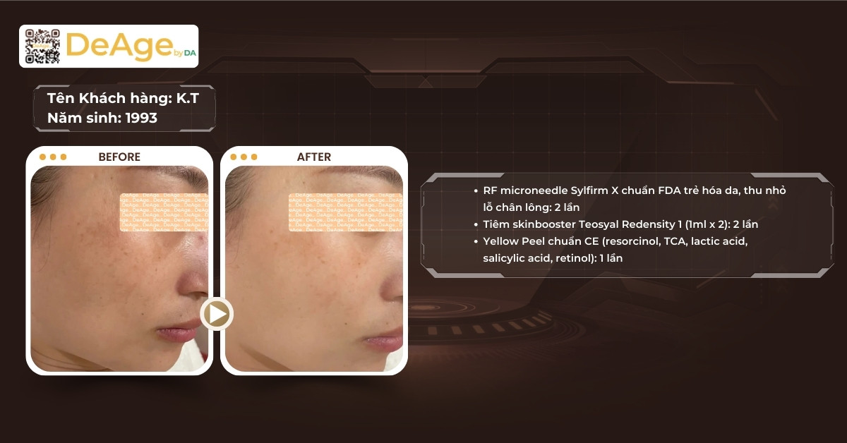 Peel da trị nám có hiệu quả không? Bao lâu thấy hiệu quả? 6 cls nám có peel