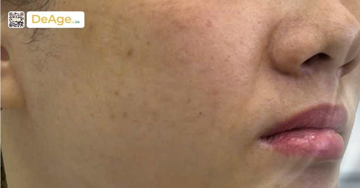 Sofwave là gì? Ưu điểm nổi bật trong trẻ hóa da và đối tượng phù hợp 5 da lão hóa