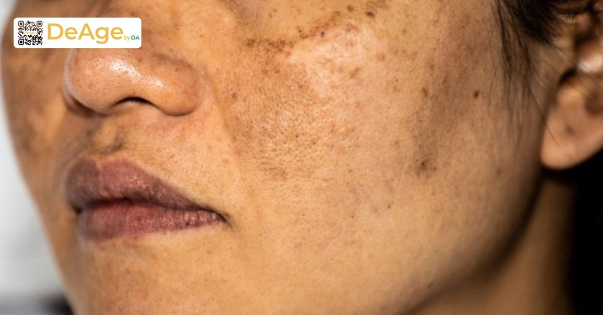 Melanin và nám da: chuyện gì xảy ra dưới da mỗi ngày? 5 da nám