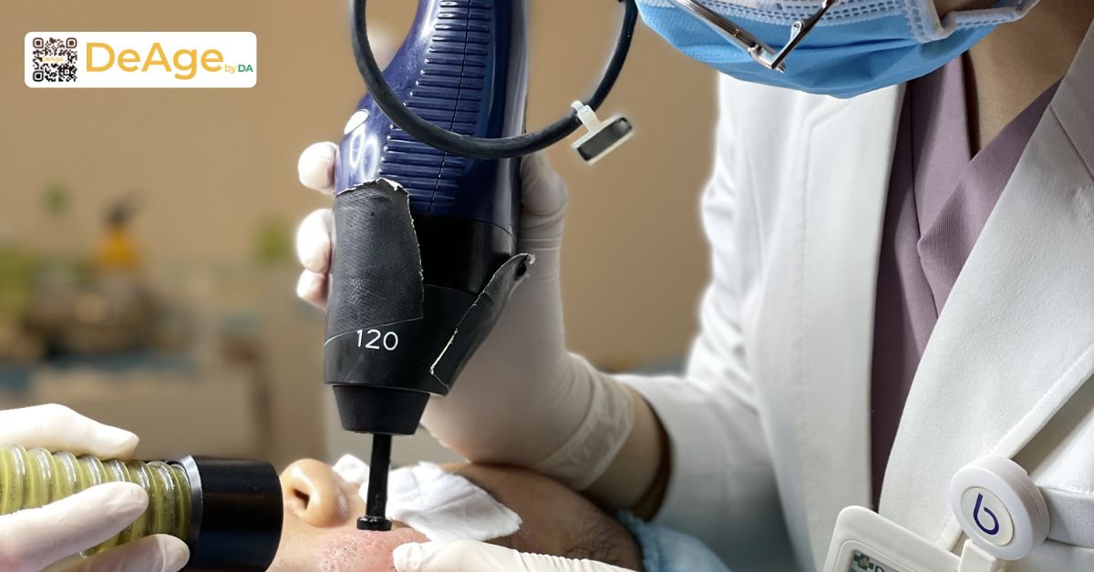 Nếp nhăn tĩnh: dấu hiệu nhận biết, nguyên nhân và giải pháp cải thiện 9 frac co2