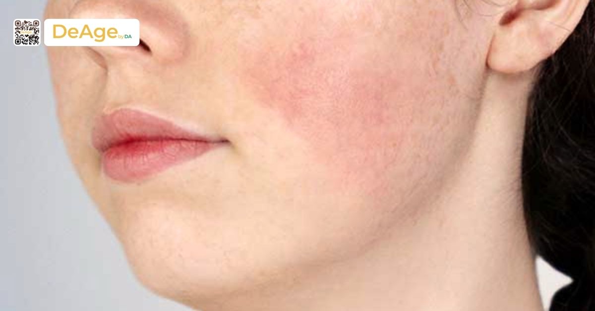 Sofwave là gì? Ưu điểm nổi bật trong trẻ hóa da và đối tượng phù hợp 7 mẩn đỏ