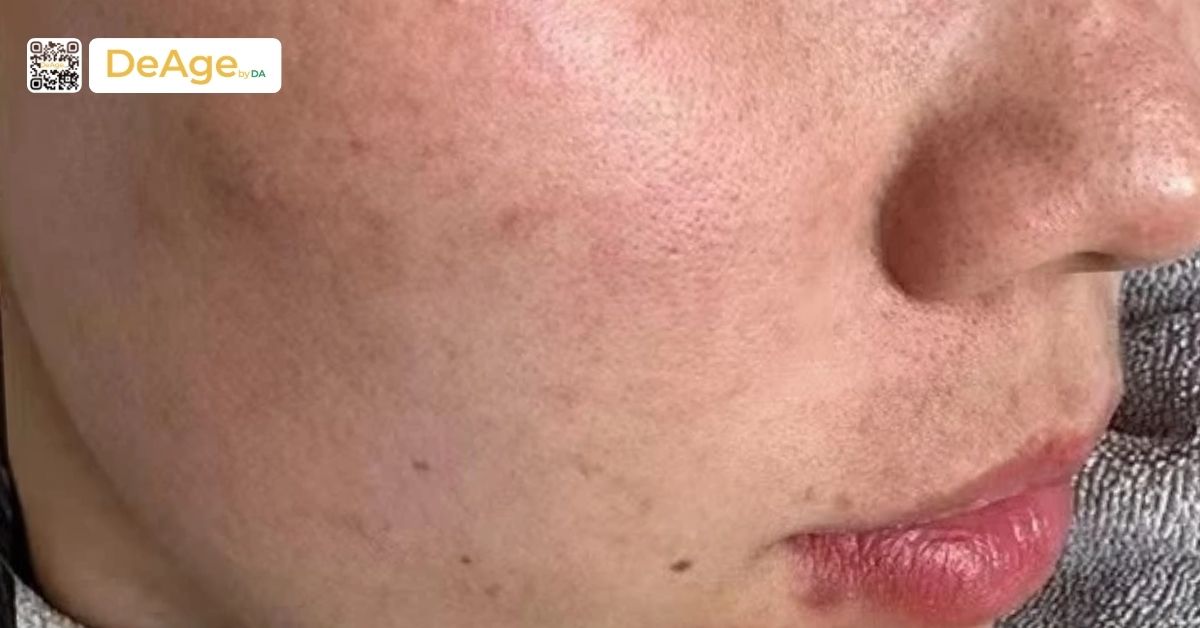 Succinic acid là gì? Lợi ích và ứng dụng trong trẻ hóa da 2 nám da