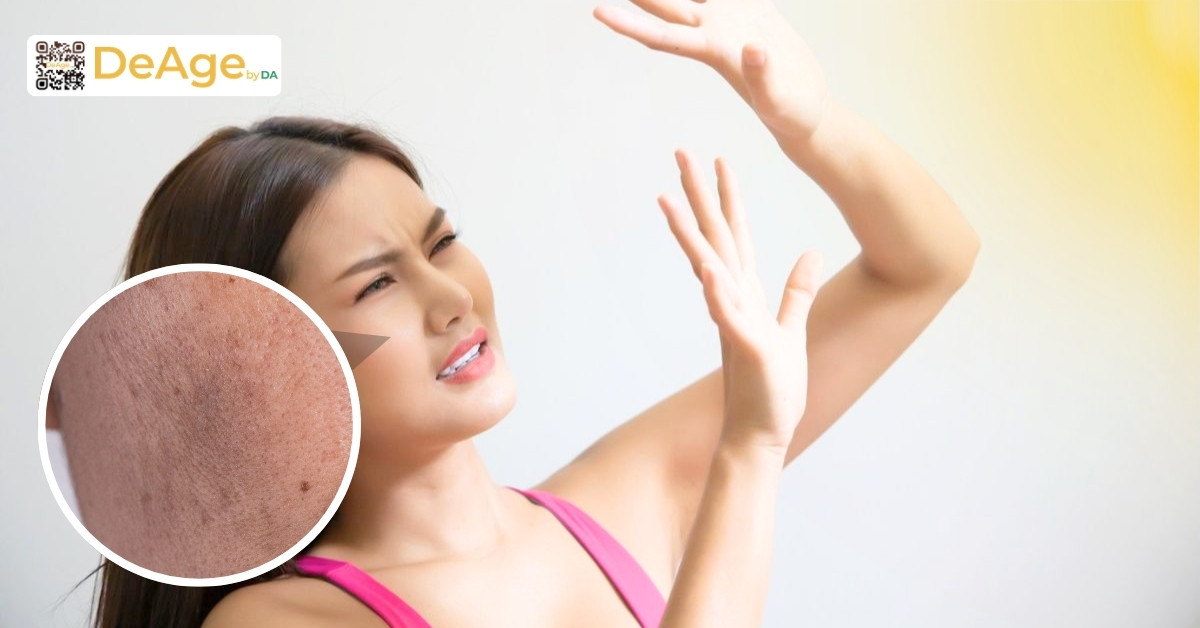 Melanin và nám da: chuyện gì xảy ra dưới da mỗi ngày? 3 nám do nắng