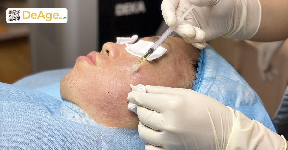 Giải đáp: trị nám bằng PRP có thực sự hiệu quả như lời đồn? 3 phản ứng tạm thời sau khi thực hiện liệu trình mesotherapy