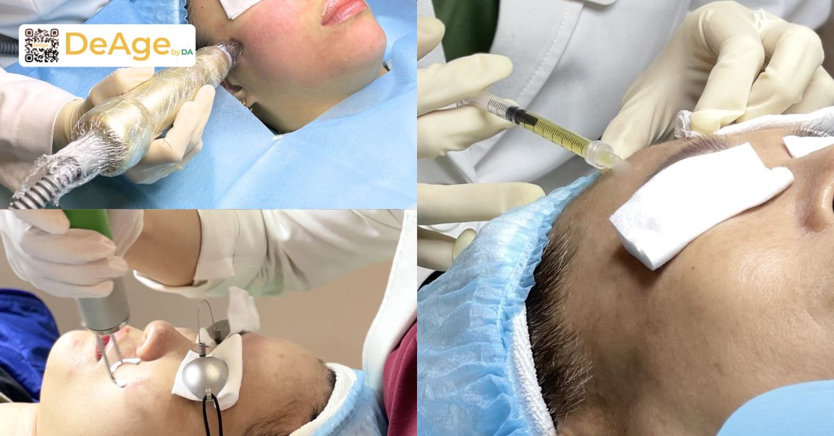 Giải đáp: trị nám bằng PRP có thực sự hiệu quả như lời đồn? 9 phối hợp PRP trong phác đồ đa phương thức