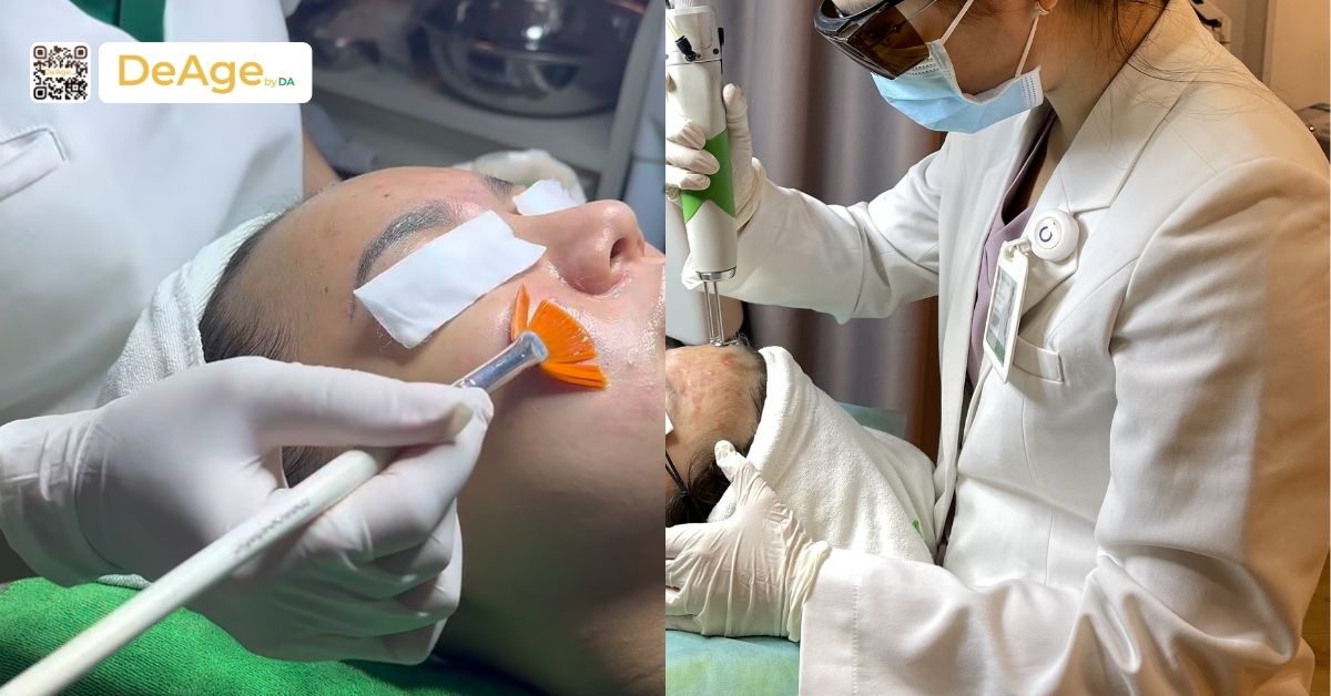 Phân biệt nám da và tàn nhang để lựa chọn phương pháp điều trị phù hợp 4 pp điều trị tàn nhang