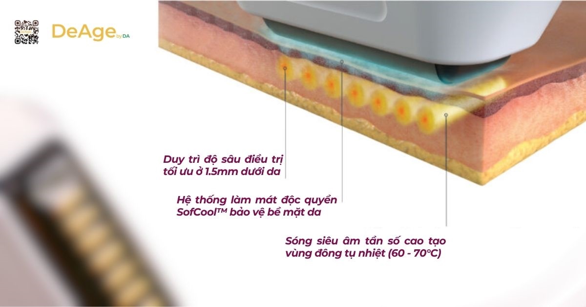 Sofwave là gì? Ưu điểm nổi bật trong trẻ hóa da và đối tượng phù hợp 3 sofwave (1)