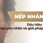 Nếp nhăn tĩnh: dấu hiệu nhận biết, nguyên nhân và giải pháp cải thiện