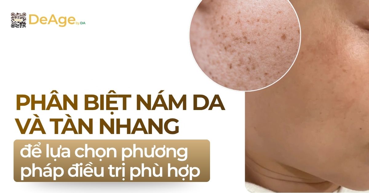 thumb phân biệt nám da và tàn nhang