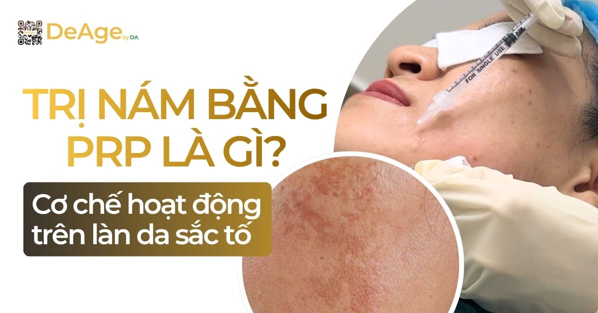 thumb trị nám bằng prp là gì